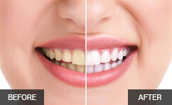 Izbjeljivanje zuba – Poliklinika La Vita profesionalno izbjeljivanje zuba uz Opalescence sustav