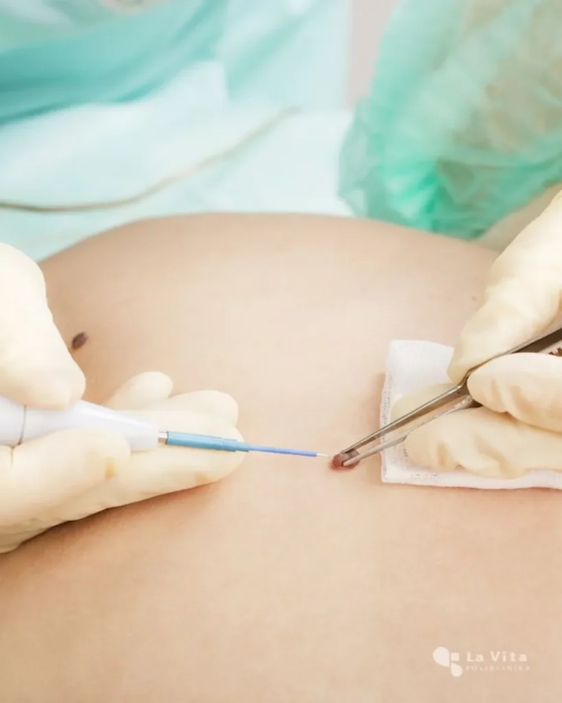 Dermatokirurgija – kirurško uklanjanje kožnih promjena Ekscizija kožne promjene u sklopu dermatokirurgije