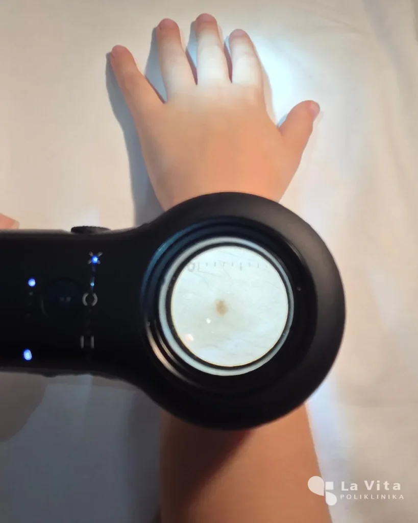 Dermatoskopija – detaljan pregled kožnih promjena Pregled madeža u sklopu dermatoskopije