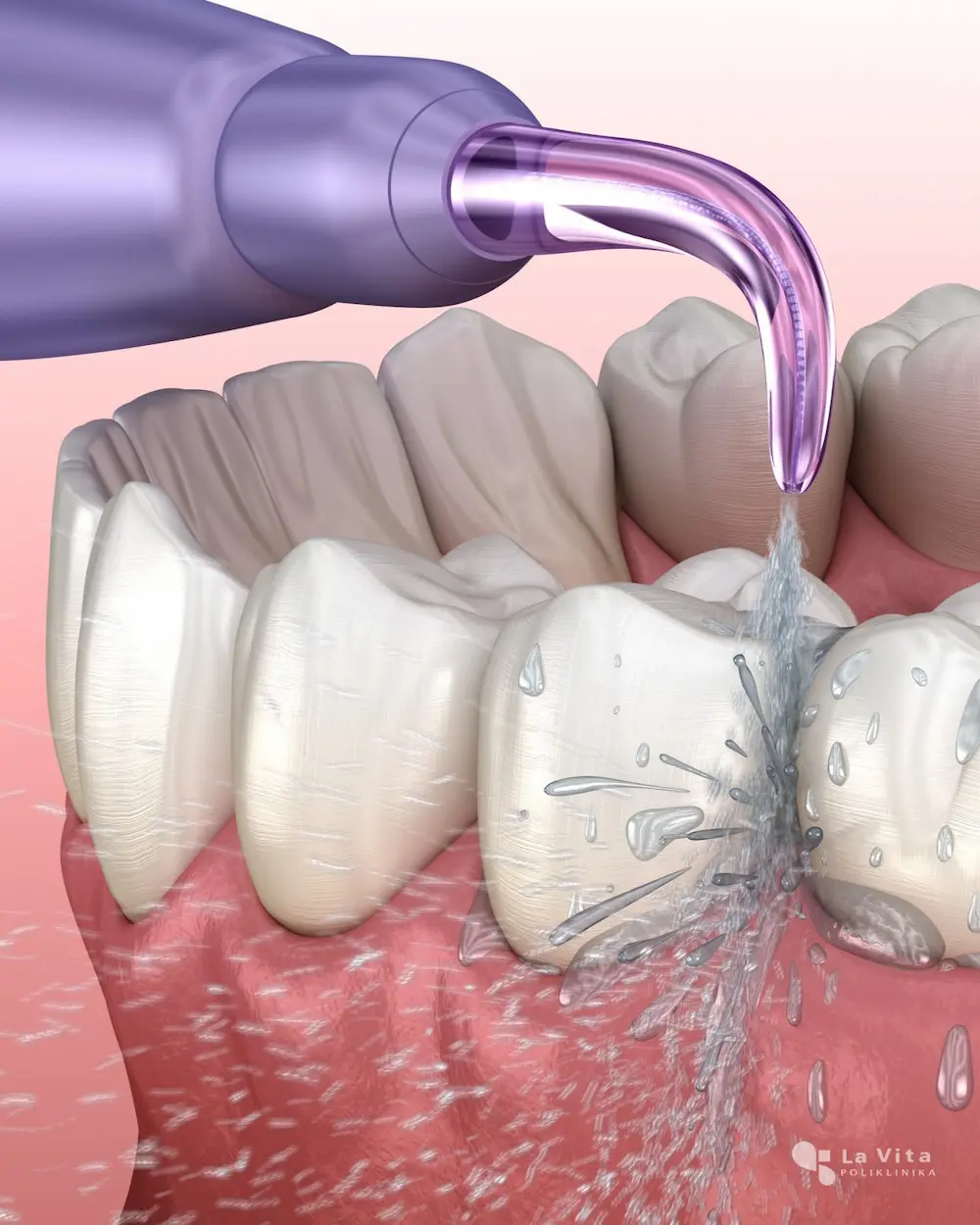 Čišćenje implantoprotetskog rada vodenim tušem