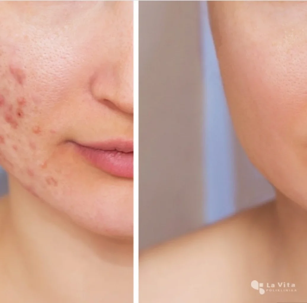 Liječenje akni u Poliklinici La Vita – dermatološki pristup