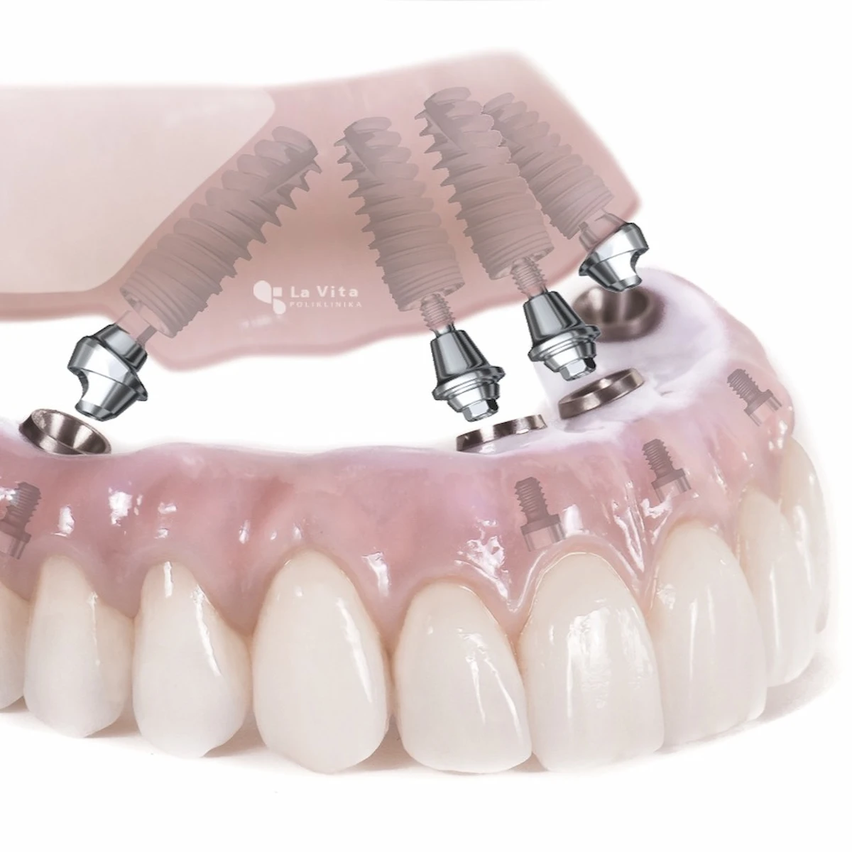 All-on-4 Zagreb – fiksni zubi na četiri dentalna implantata u Poliklinici La Vita