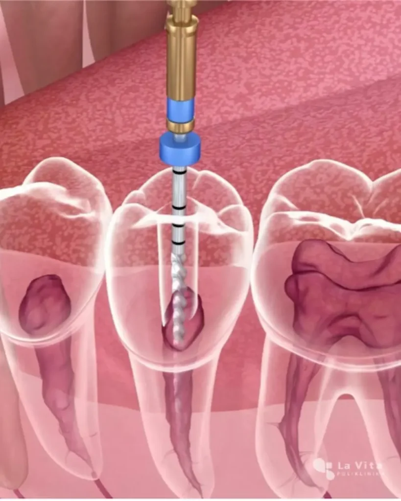 strojna endodoncija i precizno liječenje zubnih kanala