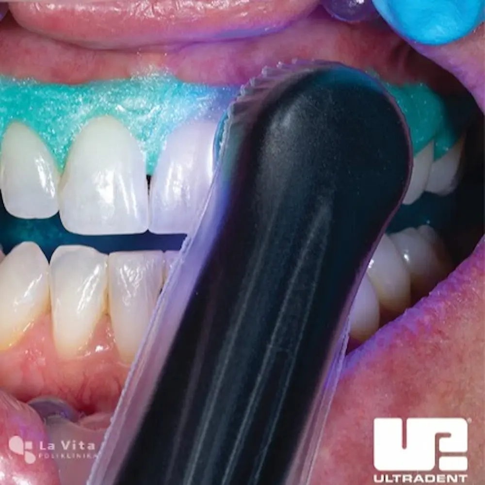 izbjeljivanje zuba u ordinaciji