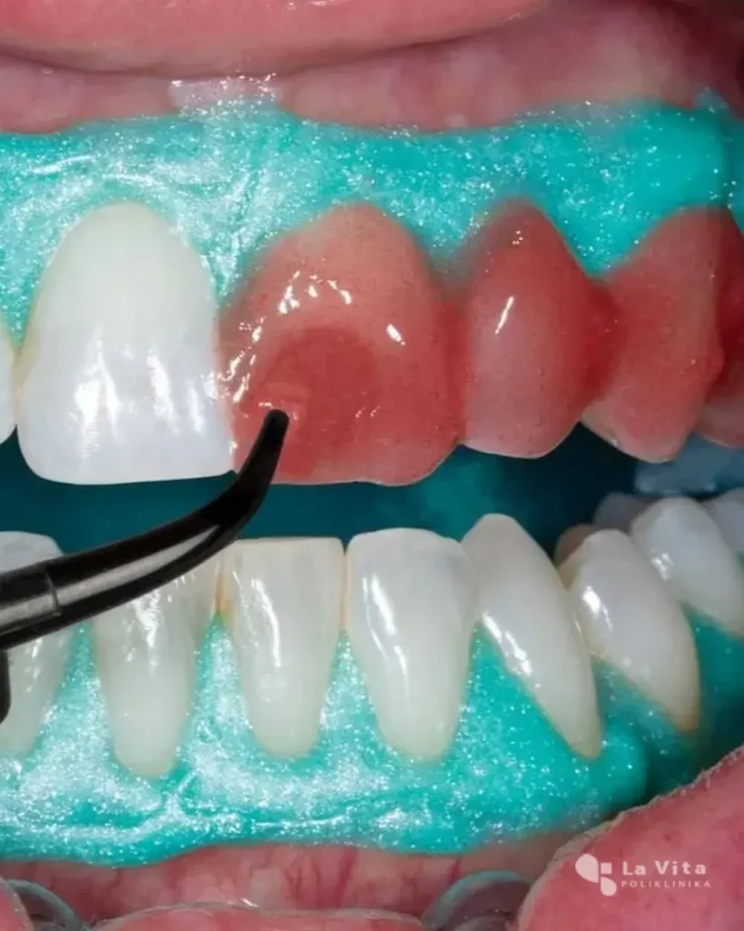 Izbjeljivanje zubi – profesionalni postupak Postupak profesionalnog izbjeljivanja zubi u ordinaciji