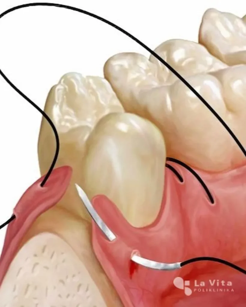 Oralna kirurgija – kirurško šivanje sluznice Čišćenje implantoprotetskog rada vodenim tušem kao dio svakodnevne higijene.