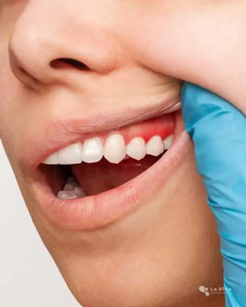 Parodontologija – Poliklinika La Vita parodontologija i liječenje parodontitisa uz suvremenu dijagnostiku