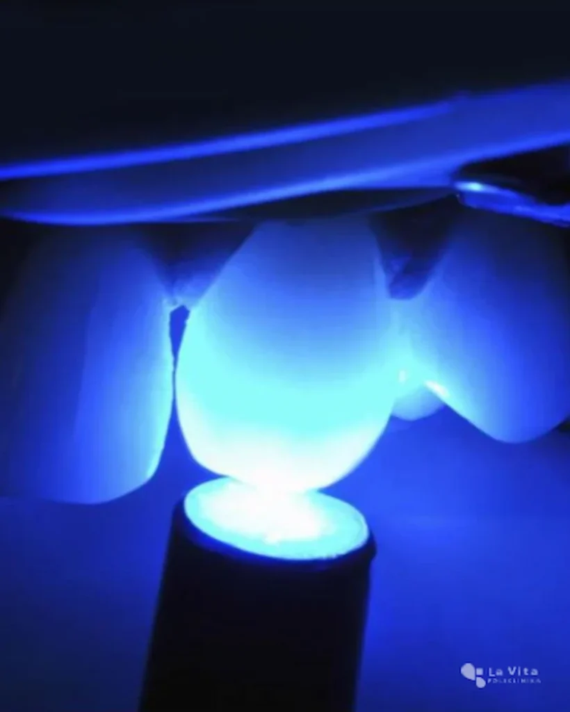 Restaurativna stomatologija – kompozitni ispun Polimerizacija kompozitnog ispuna uz LED lampu