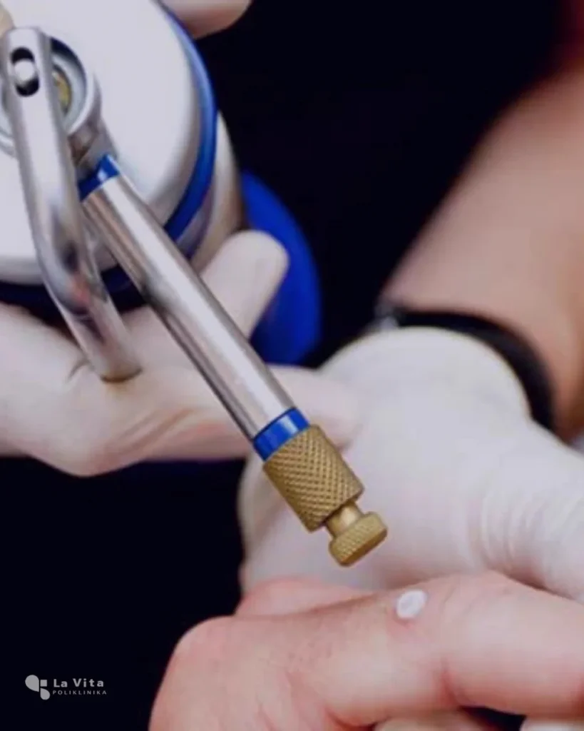 Krioterapija – uklanjanje kožnih promjena SkinPen uređaj za mikroneedling tretman.