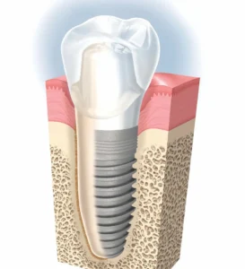 Krunica na implantatu za nadoknadu jednog izgubljenog zuba