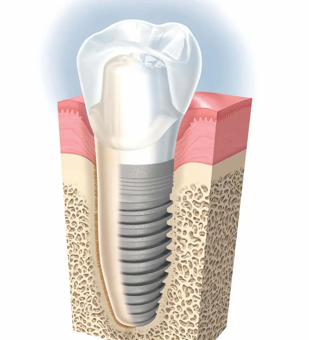 Dentalni implantat sa suprastrukturom i keramičkom krunicom za nadoknadu jednog izgubljenog zuba